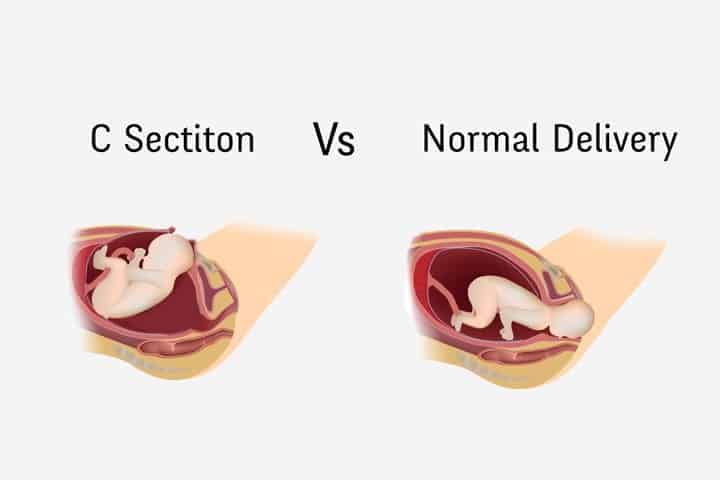 c section and vaginal birth